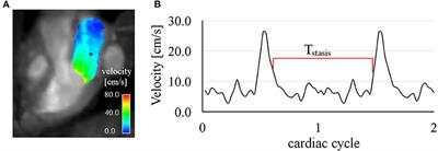 Left Atrial 4D Blood Flow Dynamics and Hemostasis following Electrical Cardioversion of Atrial Fibrillation